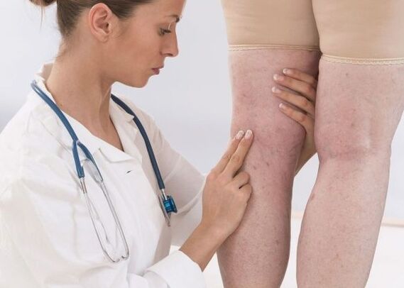 Diagnostika kŕčových žíl