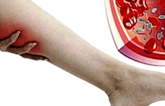 Kŕčové žily na nohe