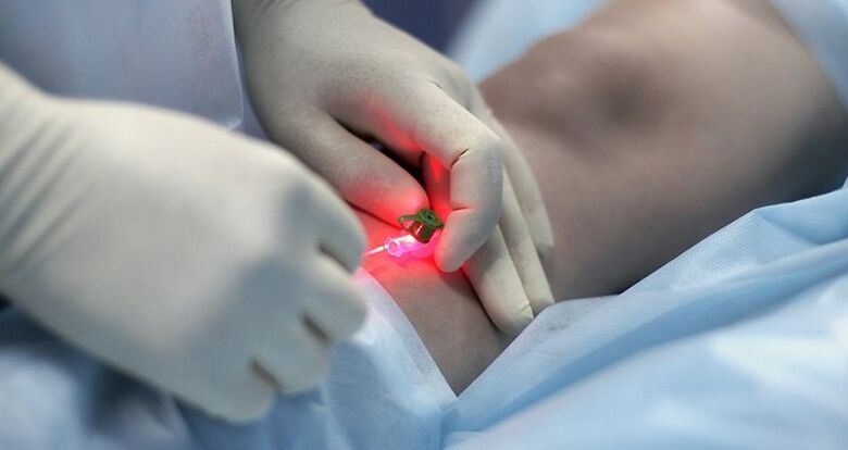 Chirurgická liečba kŕčových žíl